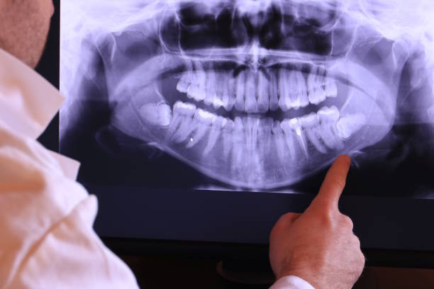 Best Knocked-Out Tooth (Avulsed Tooth) Treatment in Oli, PA